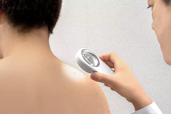 ダーモスコープの画像